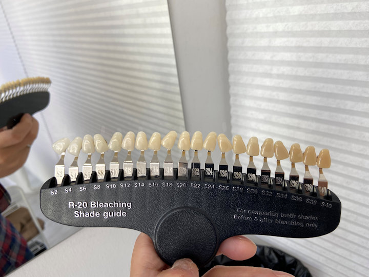 施術前の歯のトーンチェック
